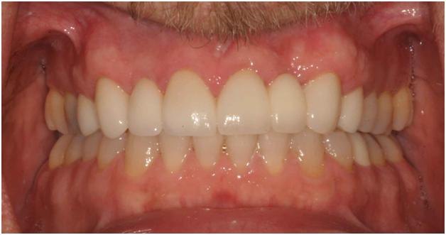 Pittsburgh periodontist picture after crown lengthening surgery