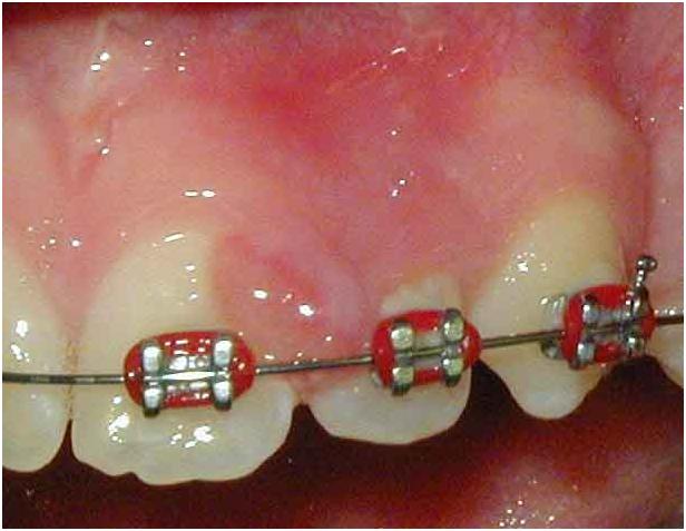 Pittsburgh periodontal biopsy before