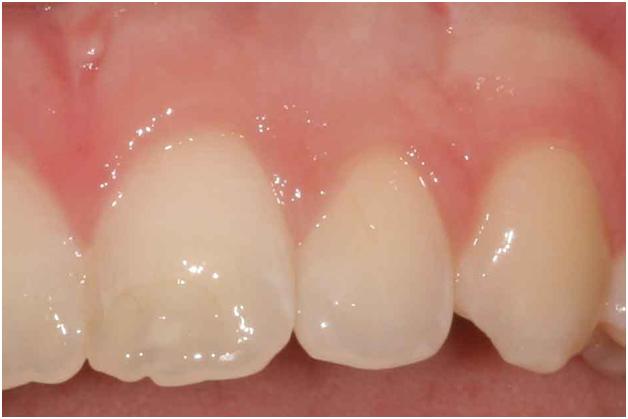 Pittsburgh periodontal biopsy after