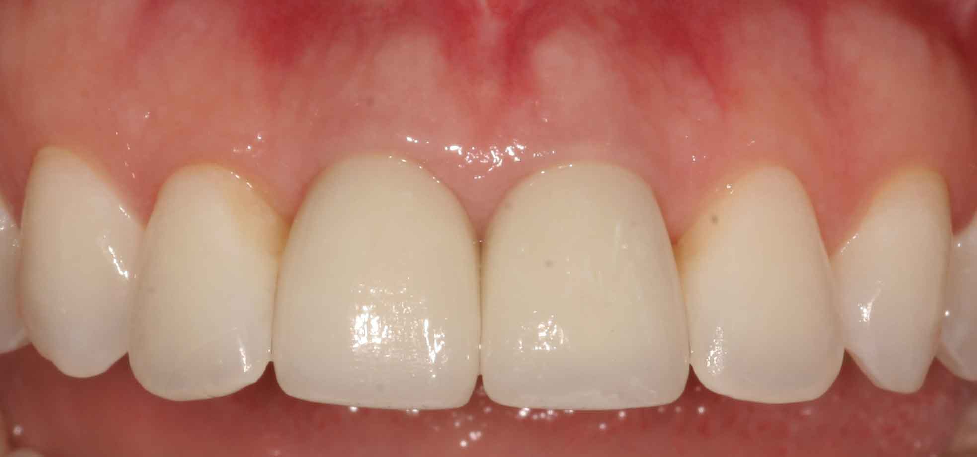 Pittsburgh Pittsburgh periodontist picture after crown lengthening