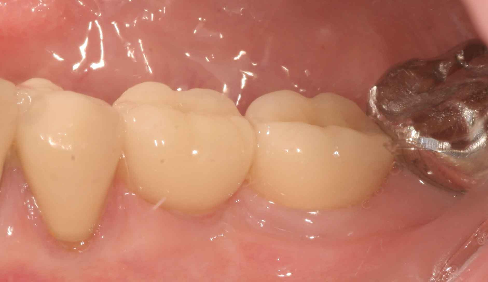 Pittsburgh periodontist picture after implants