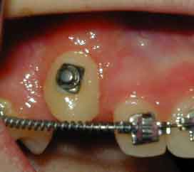 Pittsburgh periodontist picture after surgical exposure for orthodontics