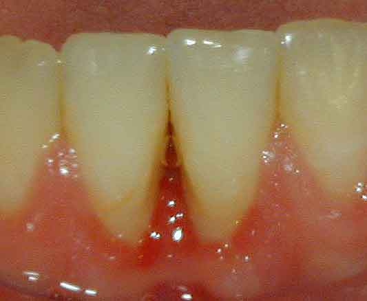 Pittsburgh periodontist picture of osteonecrosis of the jaw after treatment